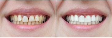 dental-implants1