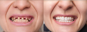 full-mouth-reconstruction