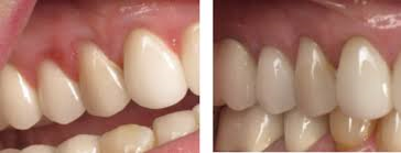 gum-disease