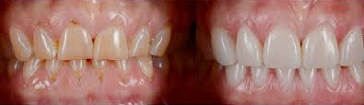 porcelain-veneers a